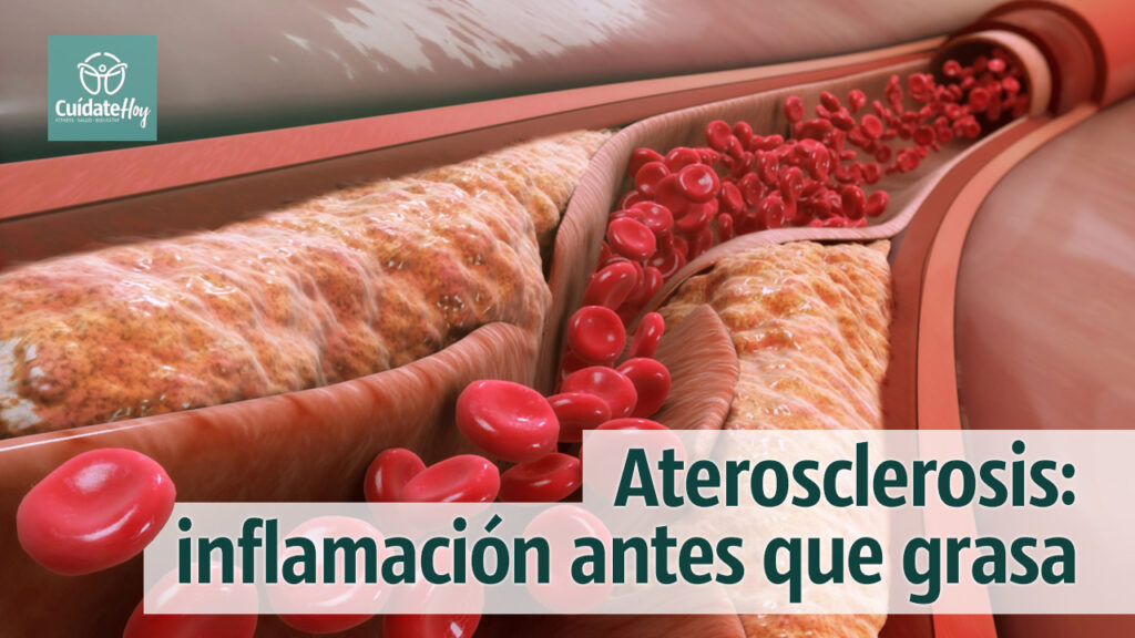 Aterosclerosis: inflamación antes que grasa en la sangre
